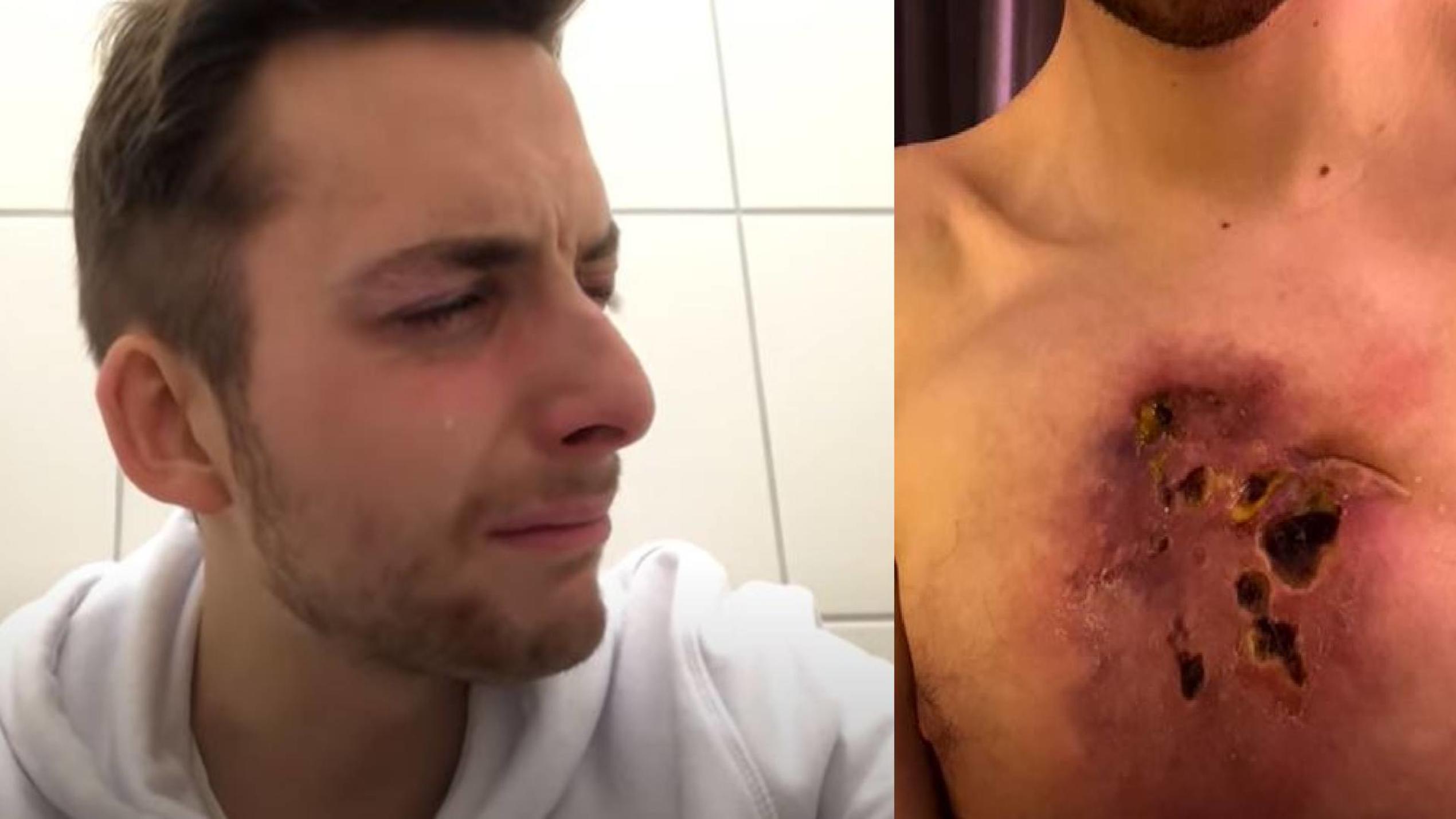 YouTube-Star Philipp Mickenbecker schockt mit Bildern seines Tumors Philipp Mickenbecker zeigt schockierende Bilder seines Tumors.