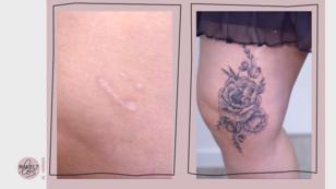 Ein Cover Up soll die Narbe verstecken Ein Cover Up soll die Narbe verstecken