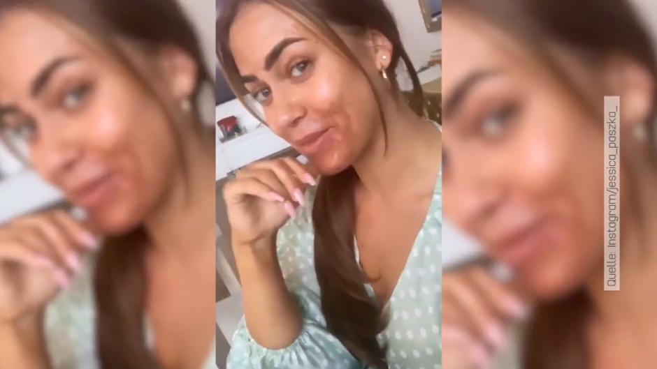 Jessica Paszka leidet nach chemischem Peeling Jessica Paszka leidet nach chemischem Peeling