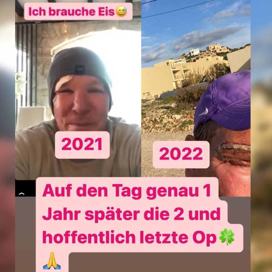Auf Instagram zeigt Steff Jerkel seine frische OP-Narbe über dem Auge. Auf Instagram zeigt Steff Jerkel seine frische OP-Narbe über dem Auge.