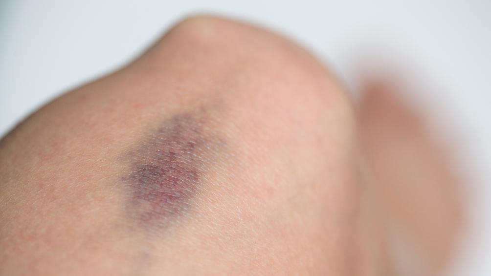 Blaue Flecken Darum ist ein Hämatom nicht immer harmlos