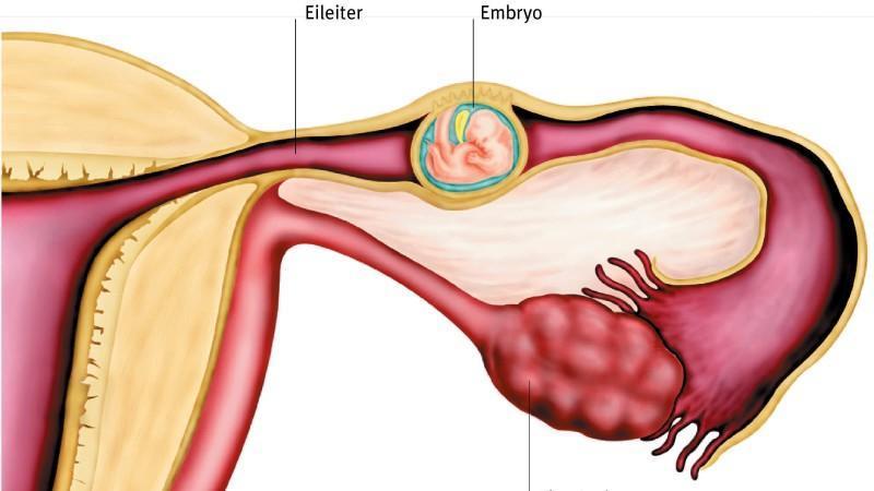 Eileiterschwangerschaft: Symptome und Behandlung