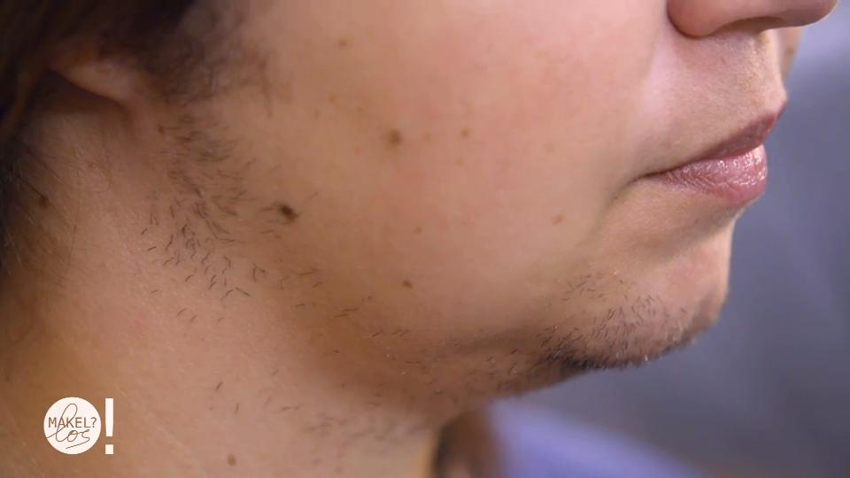 Santina leidet unter ihrer Gesichtsbehaarung