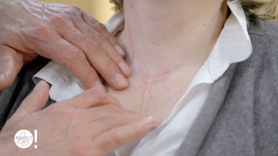 Astrids Narbe erinnert noch an ihre Krankheit
