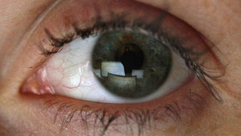 Hypertensive Retinopathie