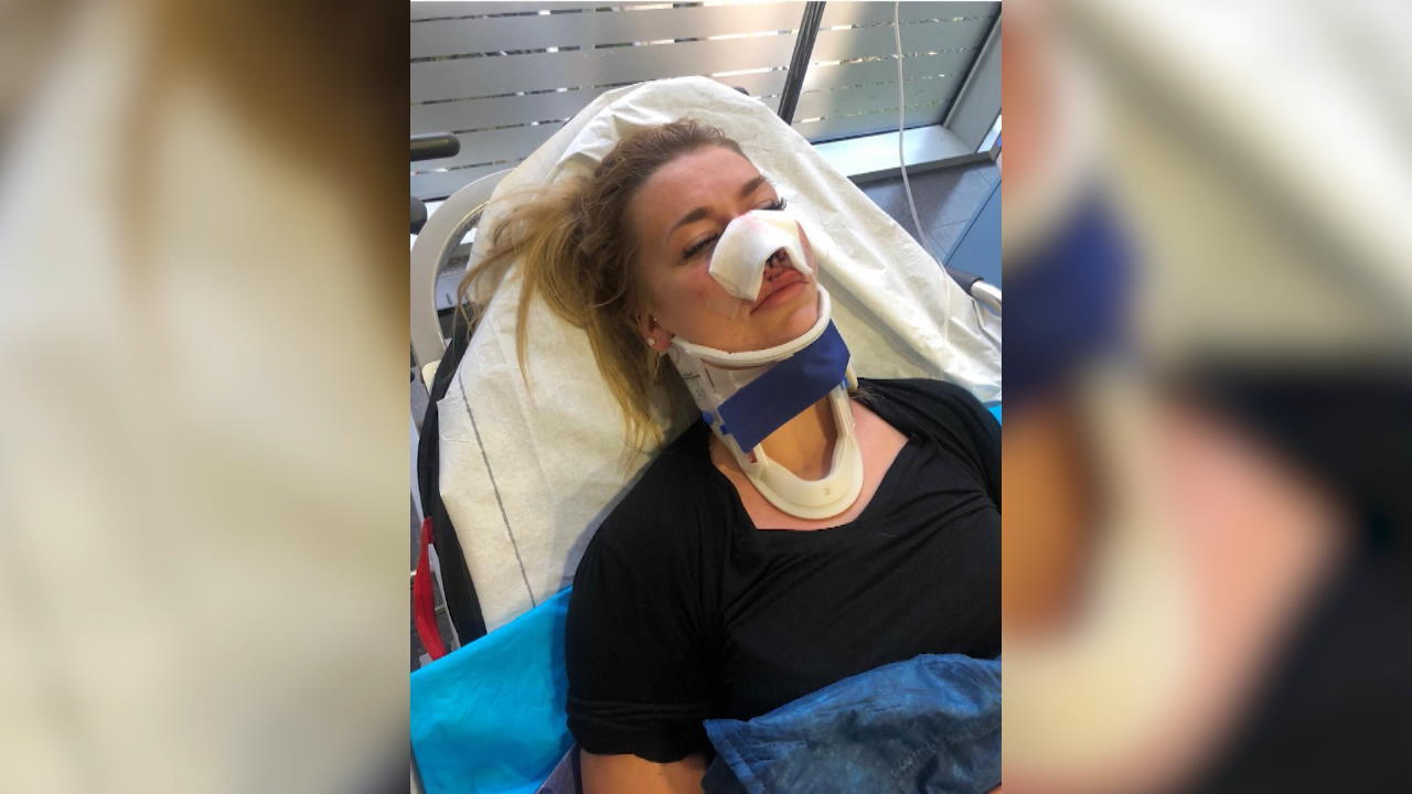 Miriam Behrens: Nase gebrochen nach E-Roller-Crash