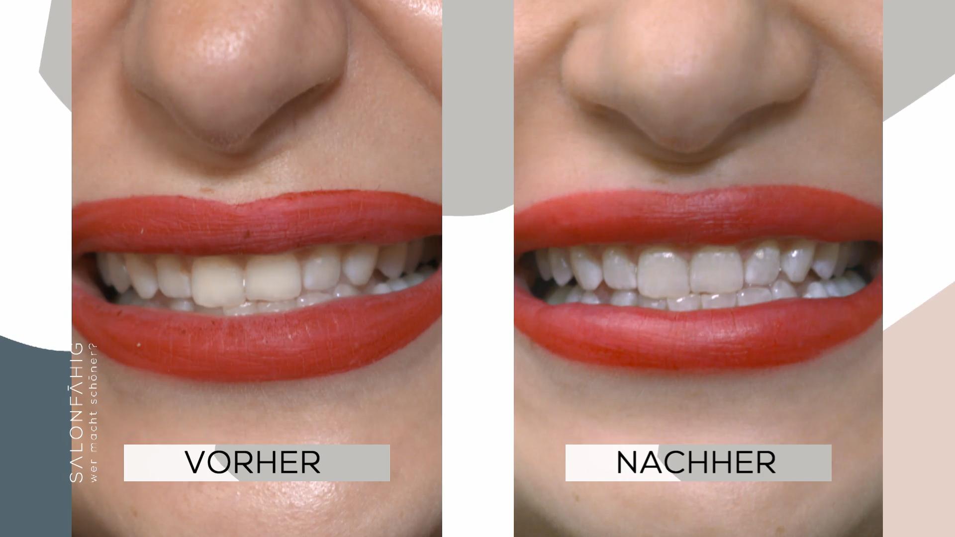 Beim Zahn-Bleaching sieht man den Effekt