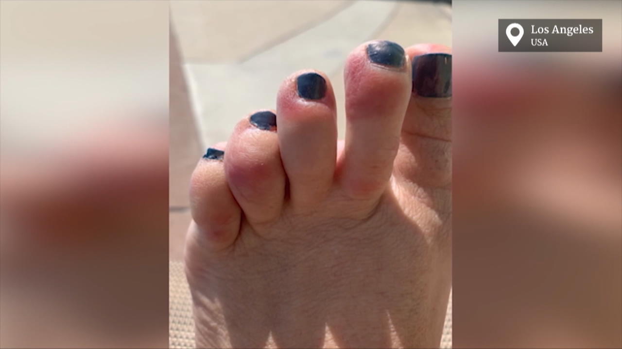 Hautausschläge mögliches neues Corona-Symptom