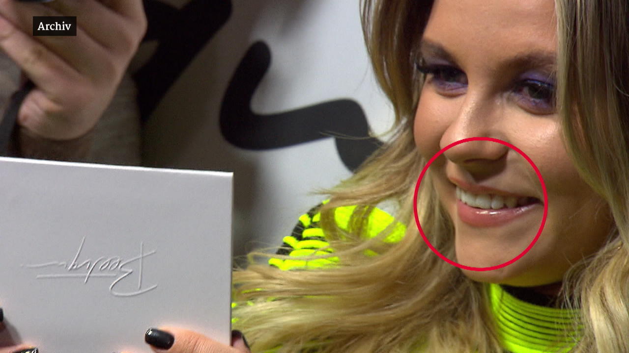 Youtuberin Dagi Bee hat sich die Lippen machen lassen