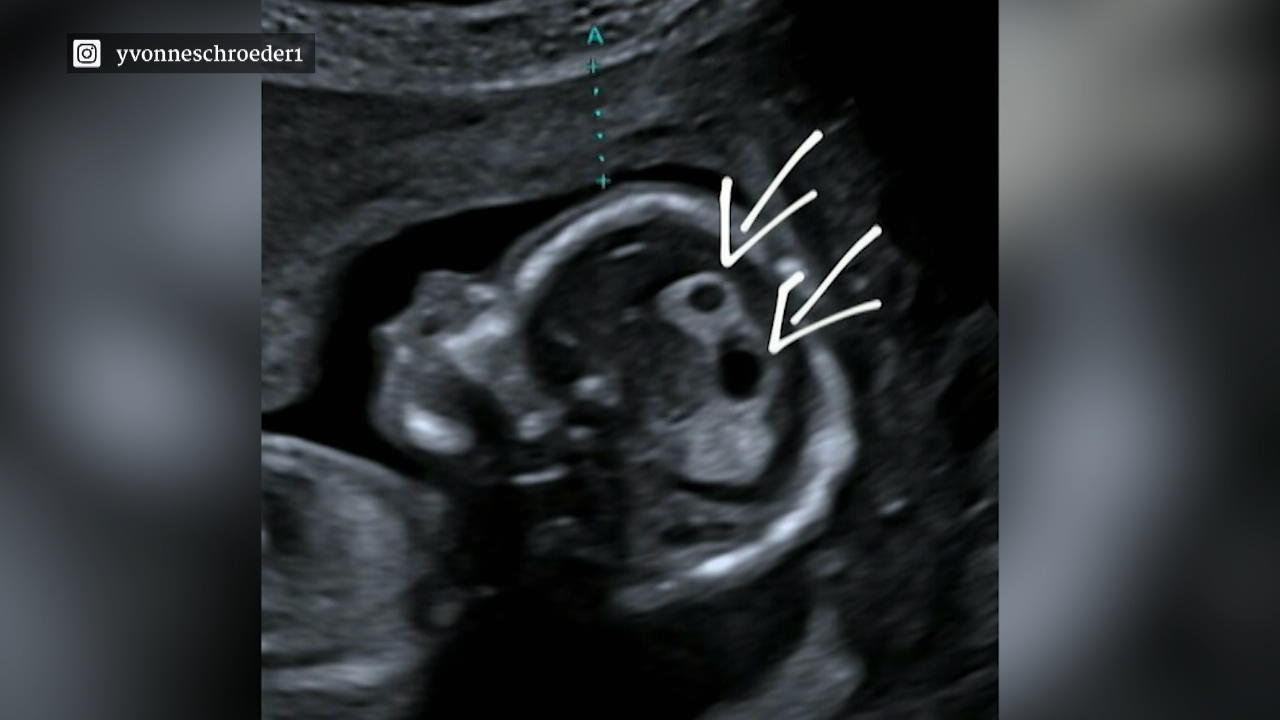 Yvonne Schröders ungeborenes Baby hat Zysten im Kopf