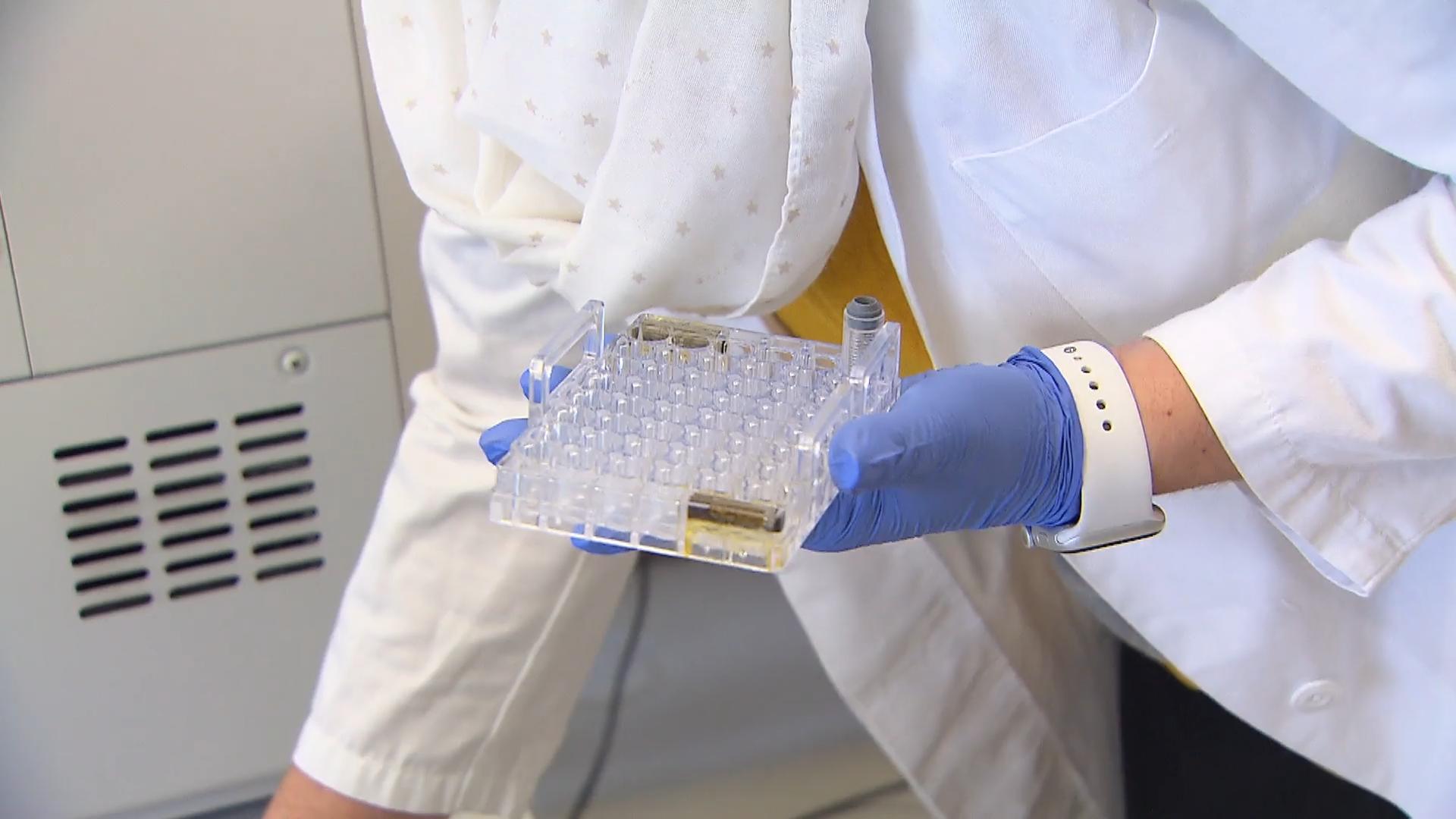 Urintest erkennt schweren Corona-Verlauf frühzeitig