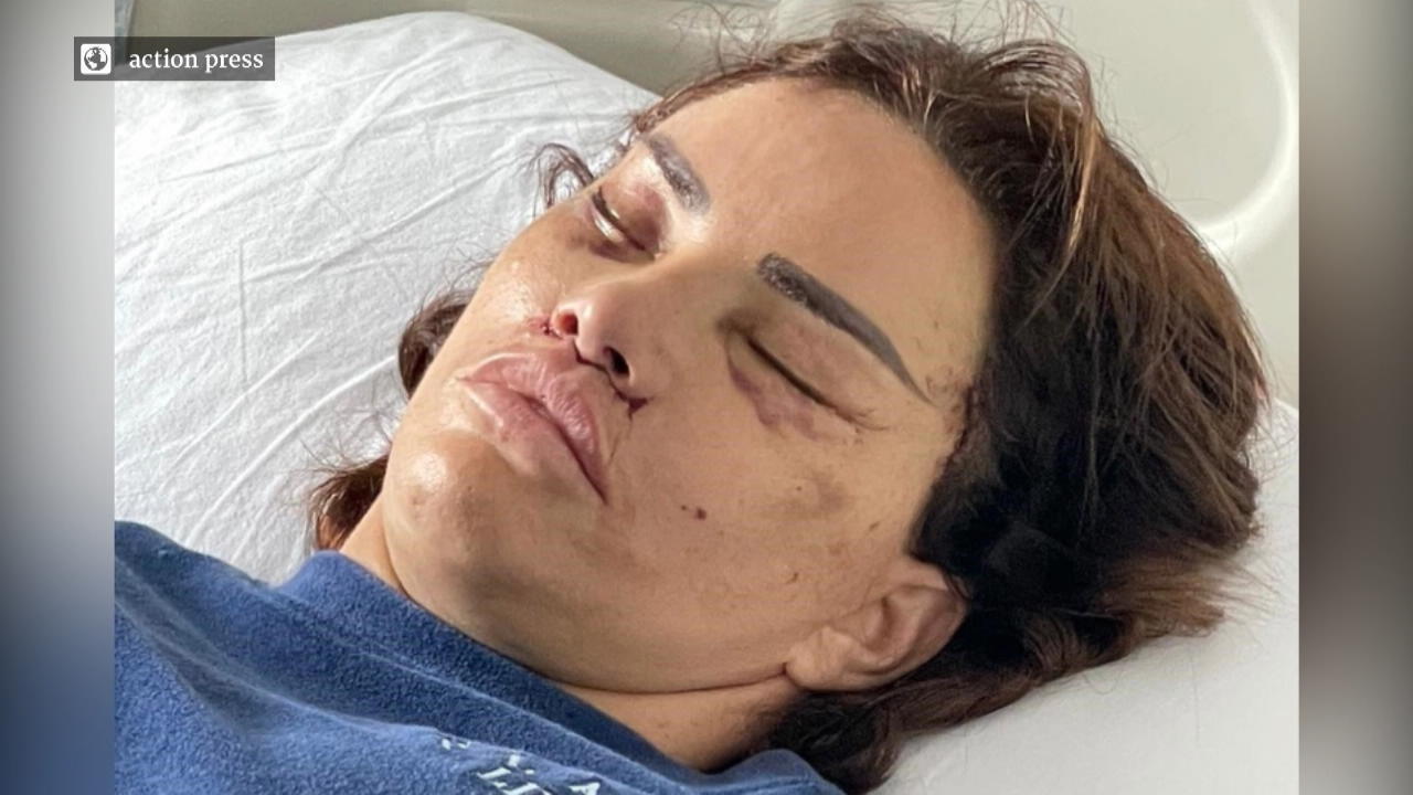 Katie Price zeigt ihr "neues" Gesicht nach OP