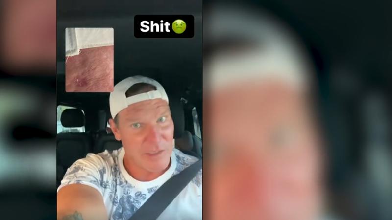 Sommerhaus-Star Steff Jerkel hat Hautkrebs
