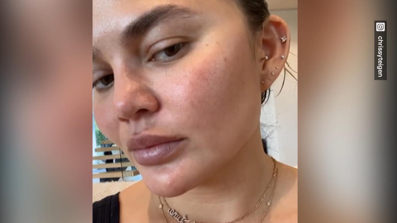 Model Chrissy Teigen zeigt uns ihre unreine Haut