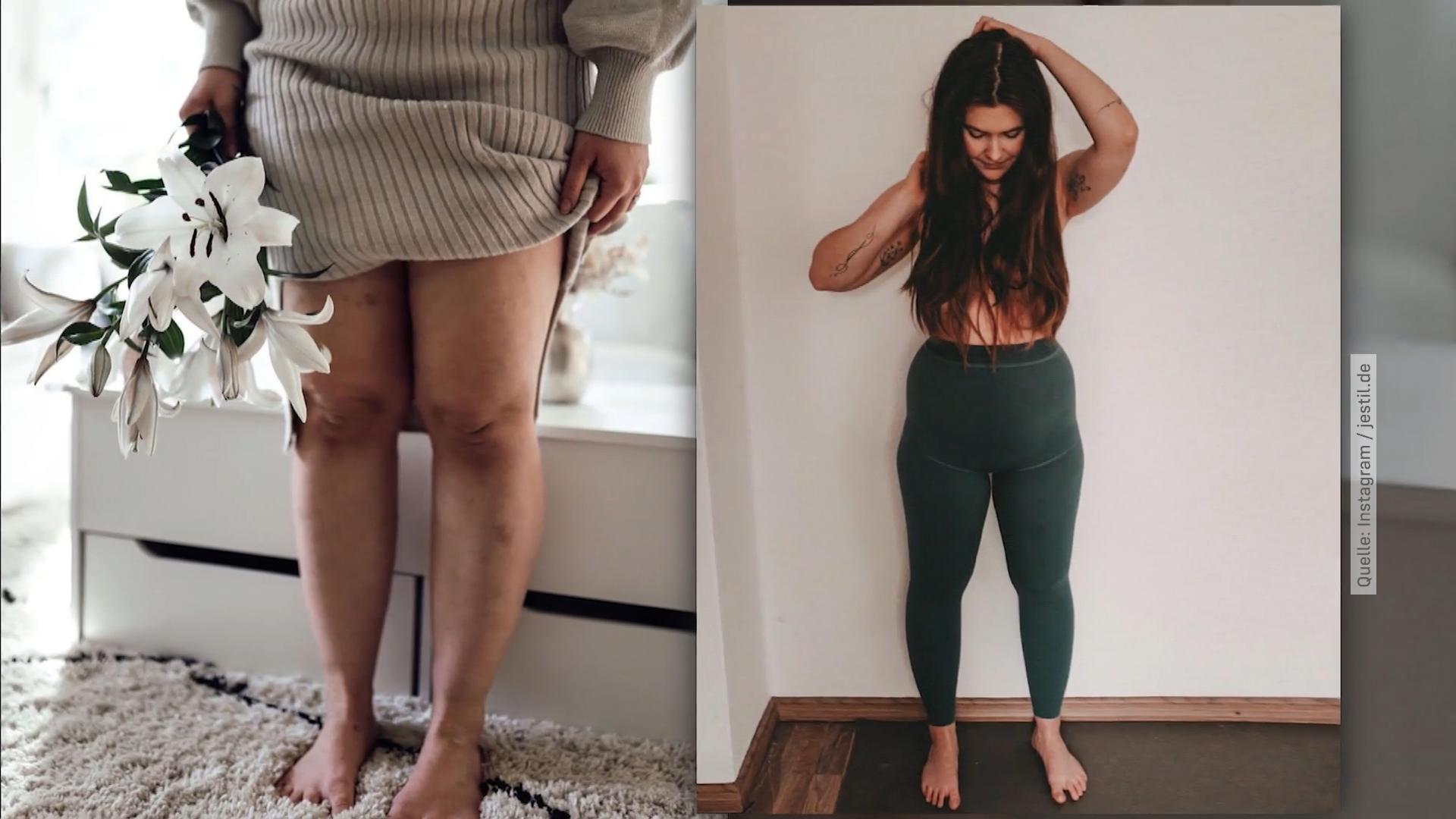 Ein Jahr nach Lipödem-OP: Wie geht es Jennifer heute?